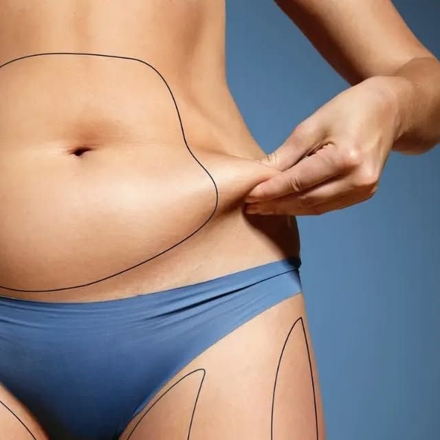 Abdominoplasty tummy tuck surgery showing abdominal contouring and cosmetic procedure