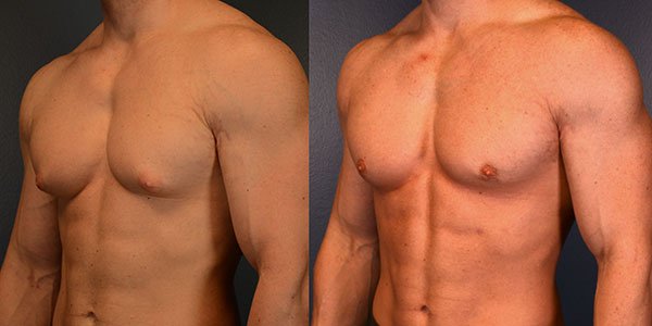 Gynecomastia surgery showing male breast reduction