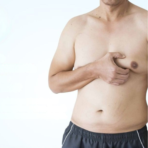 gynecomastia
