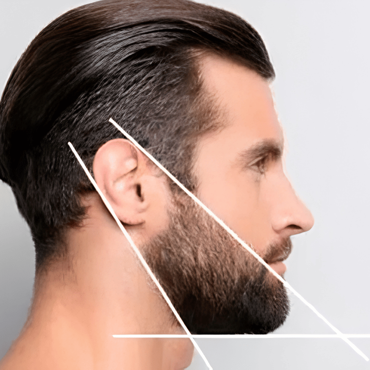 Laser beard shaping treatment showing precise facial hair contouring and grooming
