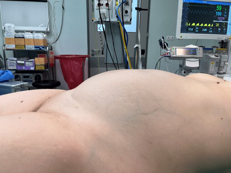A 9.8 Kilogram Fibroid case on pubmed